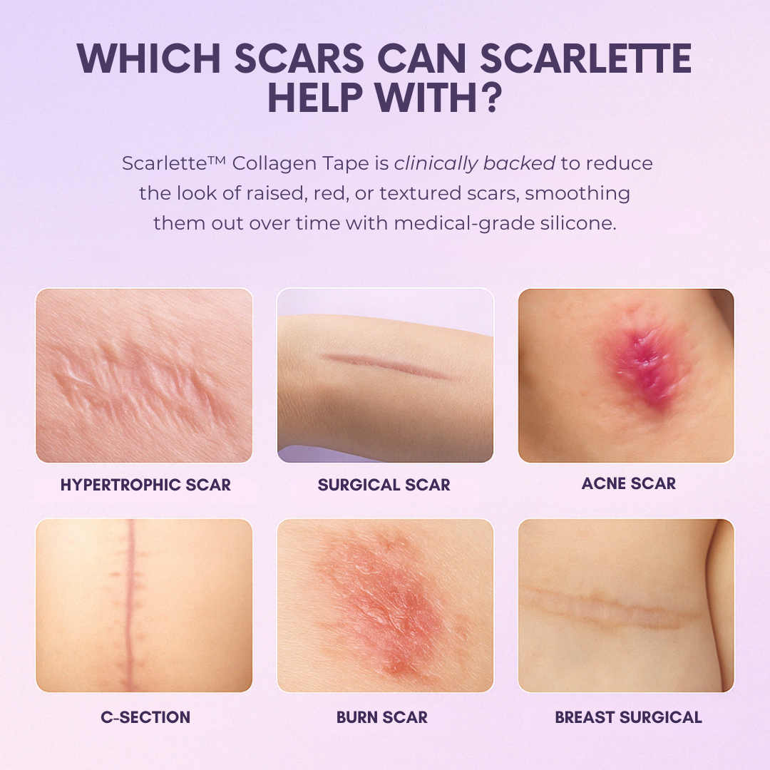 Scarlette™ Silicone Collagen Sheets